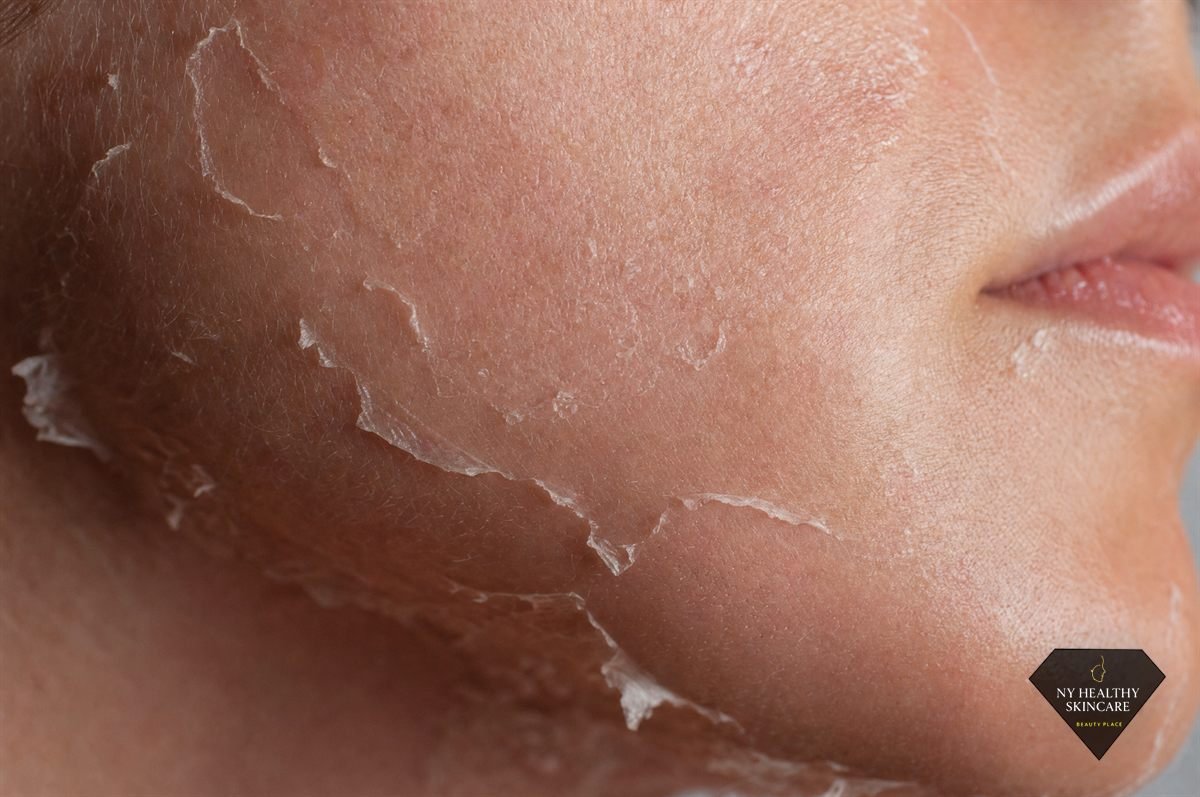Fine flakes of skin lifting during the day-by-day peeling phase after a chemical peel