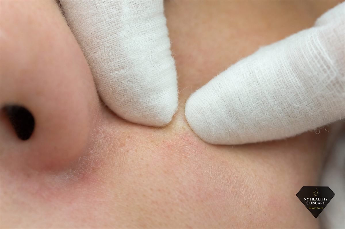 Esthetician using cotton-wrapped fingertips for safe facial extractions of blackheads under a magnifying lamp