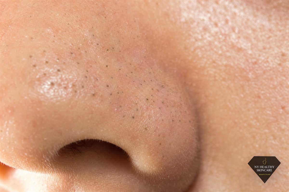 Macro close-up of congested pores and blackheads that a deep pore cleansing facial clears