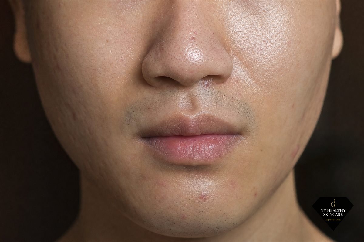Close-up of oily congested skin on the nose and chin, the skin type suited to a deep pore cleansing facial