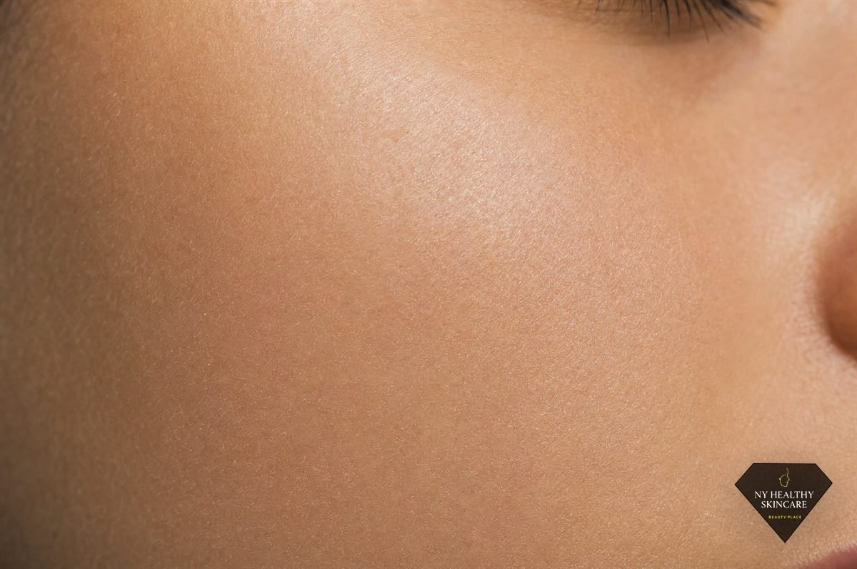 Refined skin texture with visibly smaller pores after a course of microdermabrasion